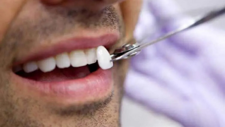 the Cost of Dental Veneers Varies by Location and Clinic