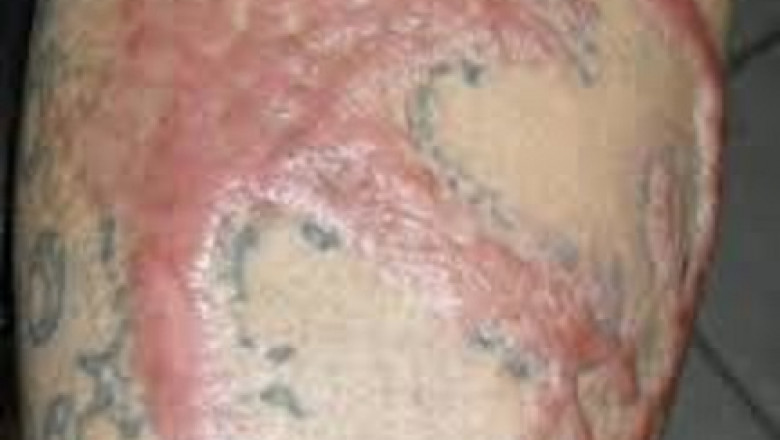 Identifying the Signs of Injury After Laser Tattoo Removal