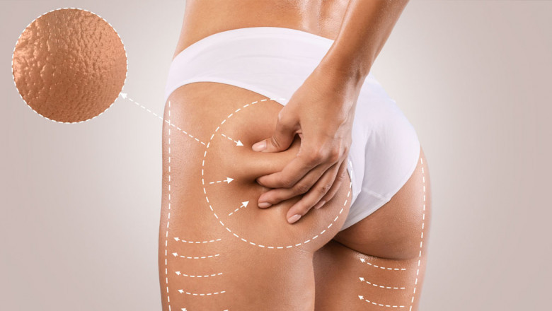 Behind the Buzz: Is Cellfina the Long-Term Solution to Cellulite?