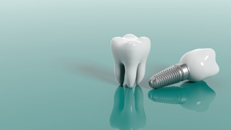 The Top 5 Benefits of Dental Implants You Might Not Know