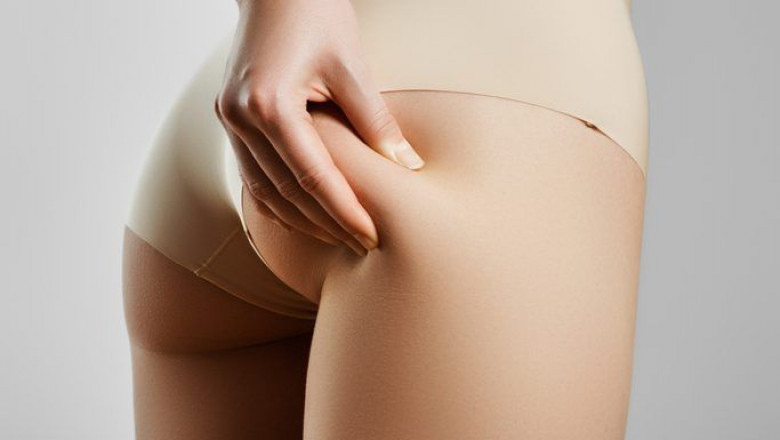 What Makes Cellfina Different from Other Cellulite Treatments?