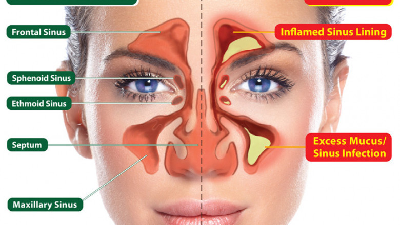 When Should You See an ENT Specialist for Sinusitis?