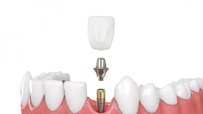 Common Myths About Dental Implants—Debunked!