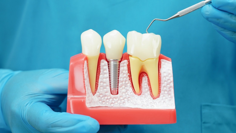 Dental Implants: A Long-Term Solution for a Healthier Smile