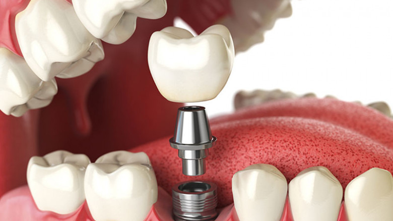 Discover the Benefits of Dental Implants in York: A Guide from Keele Crosstown Dental