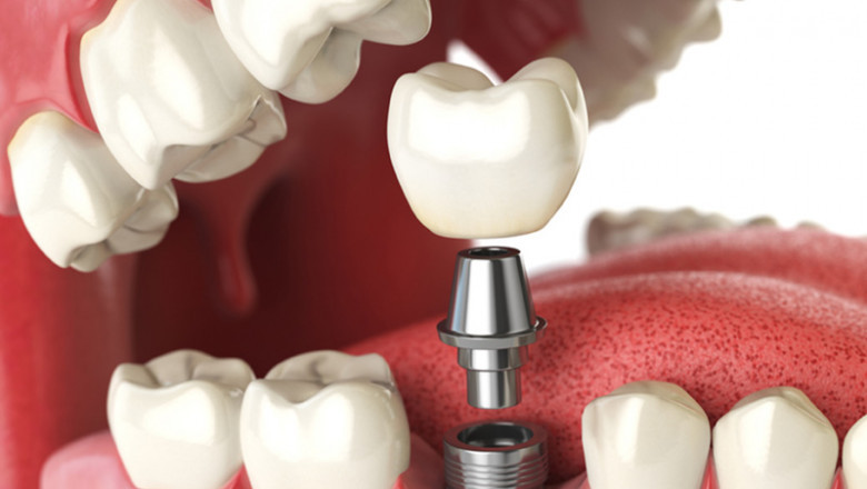 Discover the Lasting Benefits of Dental Implants in Country Hills