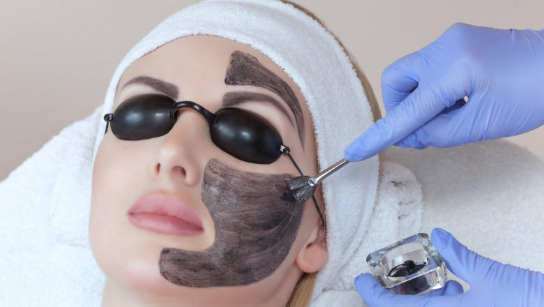 Which Is Better, Carbon Laser or Chemical Peeling for Anti-Aging