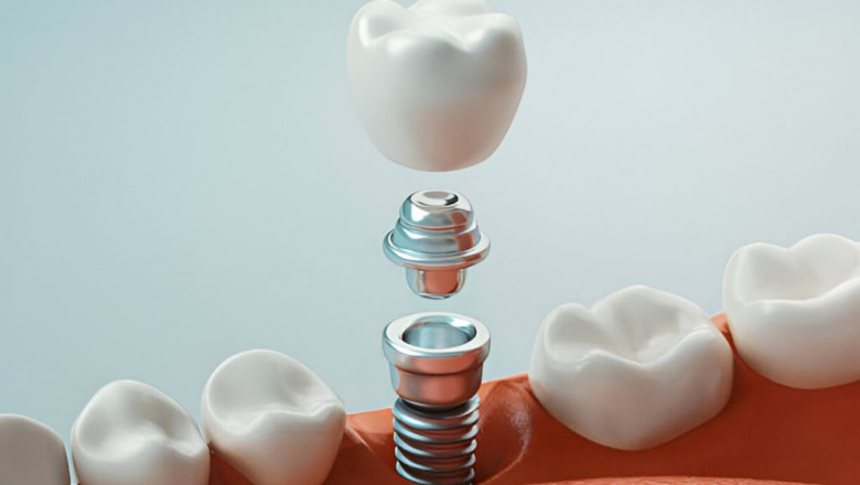 Discover the Best Dental Implants in Lakefield at Lakeflower Family Dental