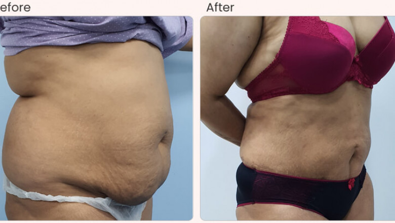 Liposuction Surgery Cost in delhi - Dr Rajat Gupta