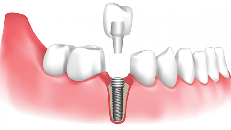 Are Dental Implants Right for You? A Jupiter Dentist Explains