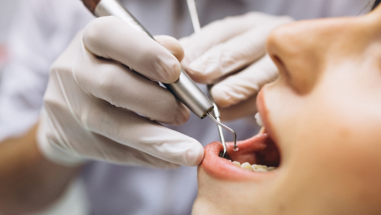 Choosing the Best Type of Dental Implants