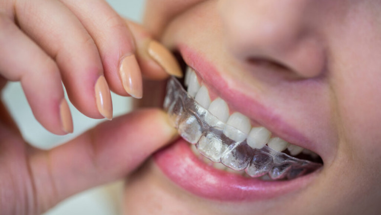 invisalign cost singapore