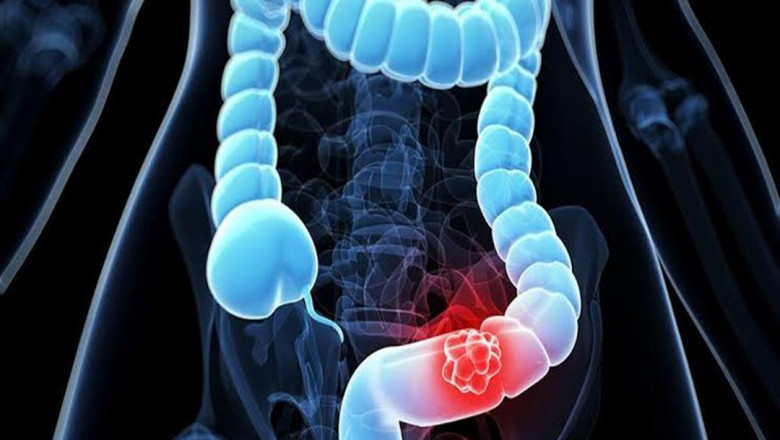 Colorectal Cancer Therapeutics: Current and Emerging Treatment Options