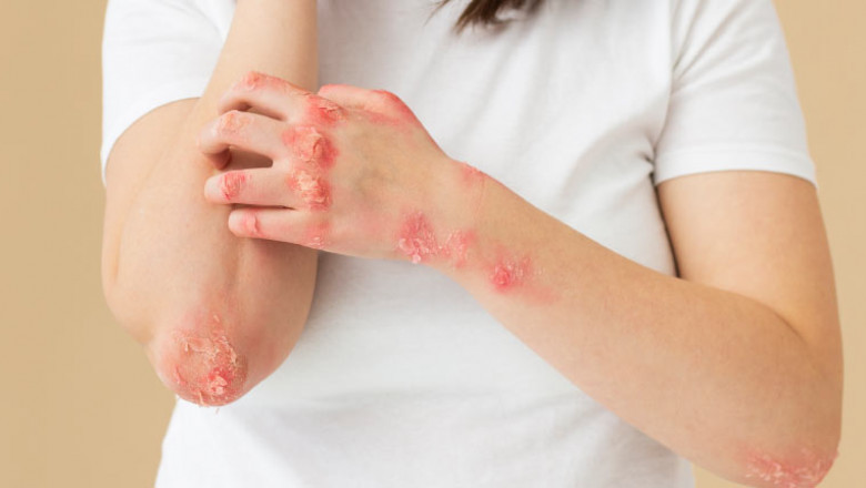Living with Eczema: Tips for Daily Management