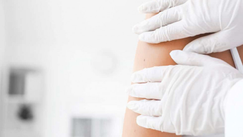 Surgical Mole Removal: Is It Worth It?