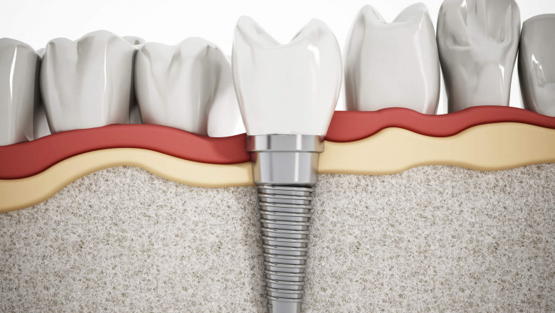 Dental Implants Explained: Key Facts You Need to Know