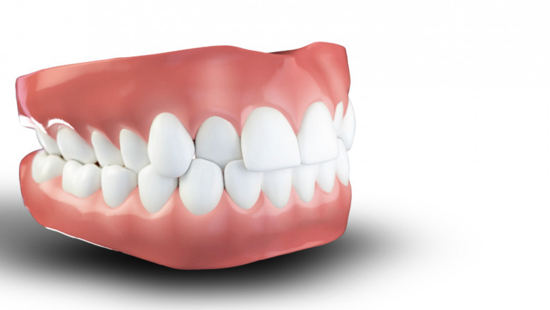 When Your Bite Feels Off: Understanding Crossbite and How to Fix It