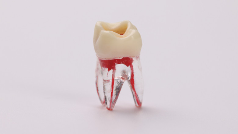 Root Canal Therapy: Saving Your Natural Smile