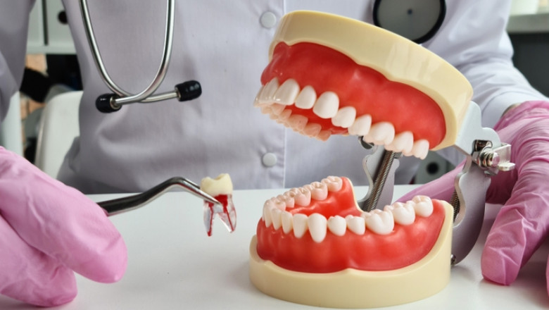 Understanding Tooth Removal: When It’s Necessary and What to Expect