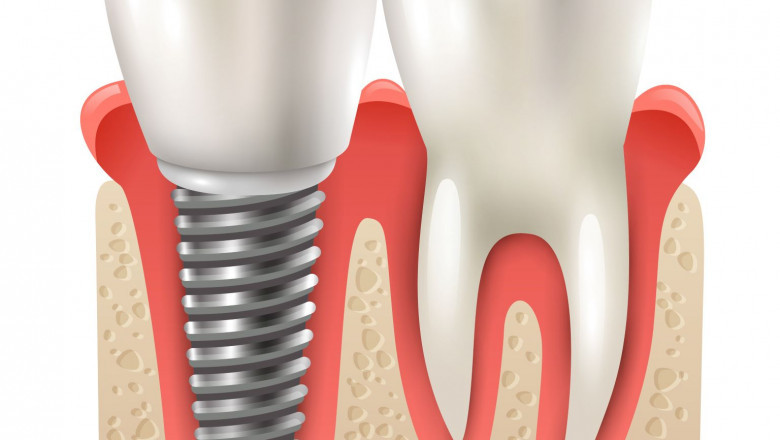 Why Dental Implants Are the Gold Standard for Tooth Replacement