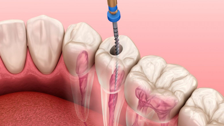 Why Root Canal Treatment in Mumbai is Your Best Dental Investment