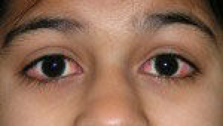 Post-Operative Care and Recovery After Cataract Surgery in Lucknow