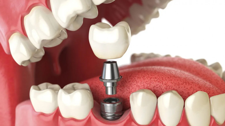 Top 5 Benefits of Choosing Dental Implants