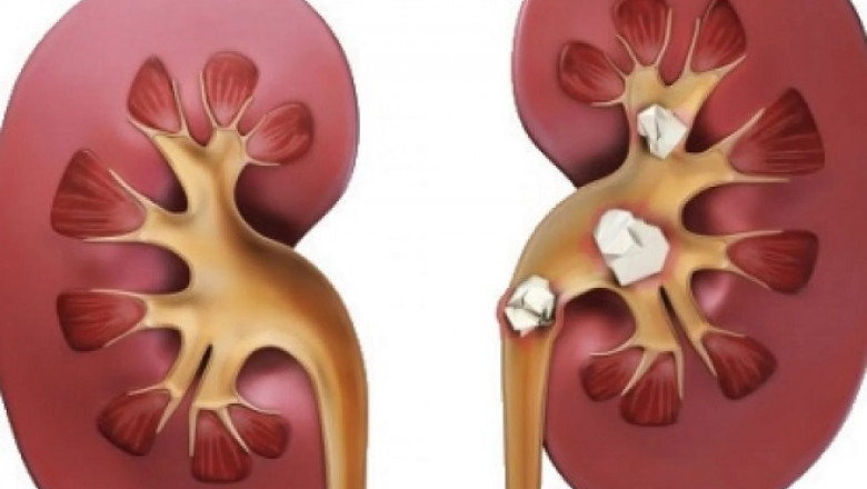 Ayurvedic Treatment For Kidney Stone: Holistic Approaches to Eliminate Kidney Stones