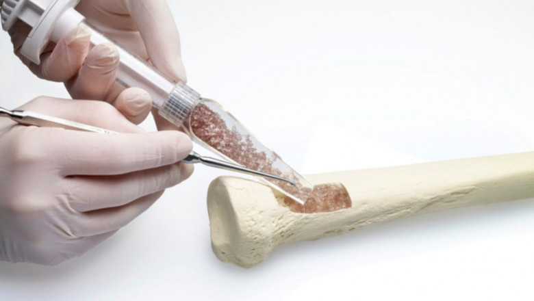 Bioactive Materials Market to See High Growth Due to Orthopedic Demand