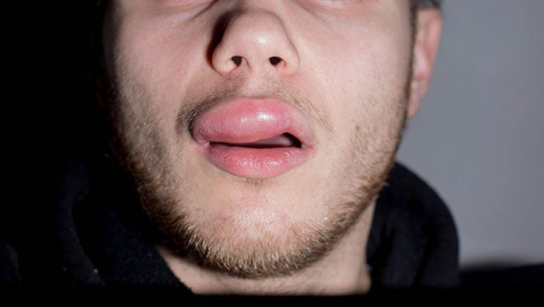 Hereditary Angioedema Market is Estimated to Witness High Growth from Kallikrein Inhibitors