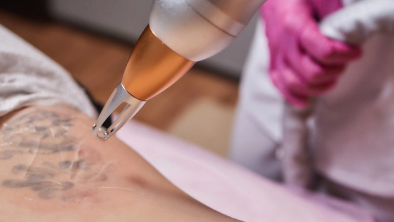 Laser Tattoo Removal Myths and Facts You Need to Know