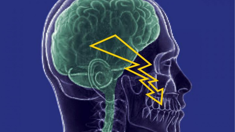 Trigeminal Neuralgia: Causes, Symptoms, and Treatment