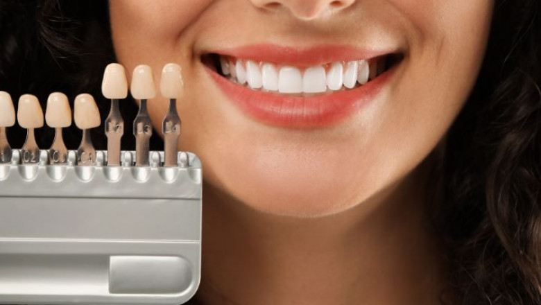 Are Dental Veneers Worth the Cost? Pros, Cons and Pricing Factors