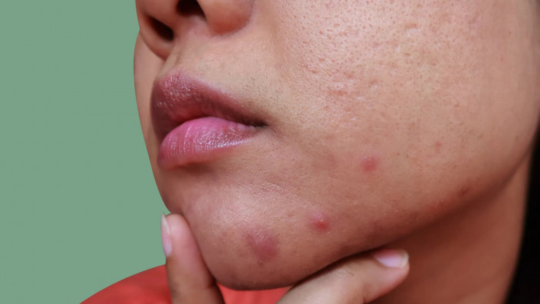 What Are the Causes of Tropical Acne?