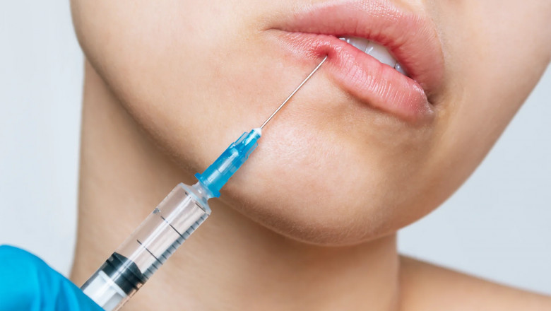 Can Lip Fillers Look Natural? Here's How to Make It Happen