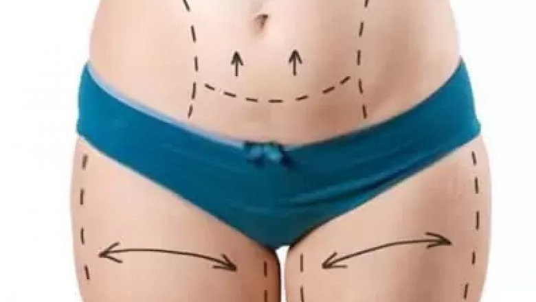 Who Is the Right Candidate for Tummy Tuck Surgery Dubai?