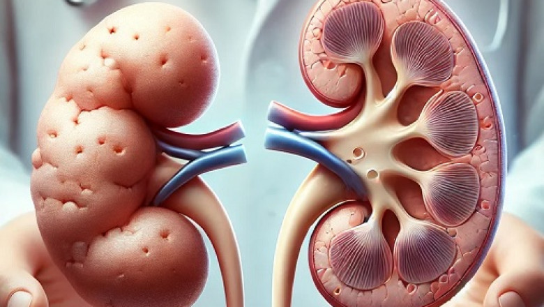 Ayurvedic Treatment For Kidney Shrinkage: Holistic Approaches to Reverse Kidney Damage