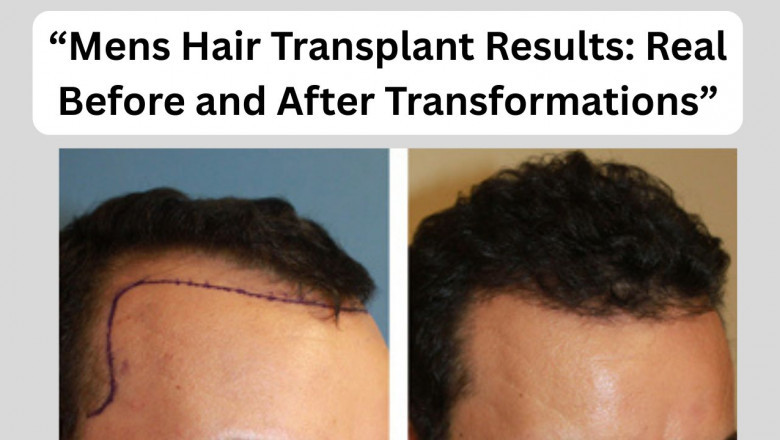 “Mens Hair Transplant Results: Real Before and After Transformations”