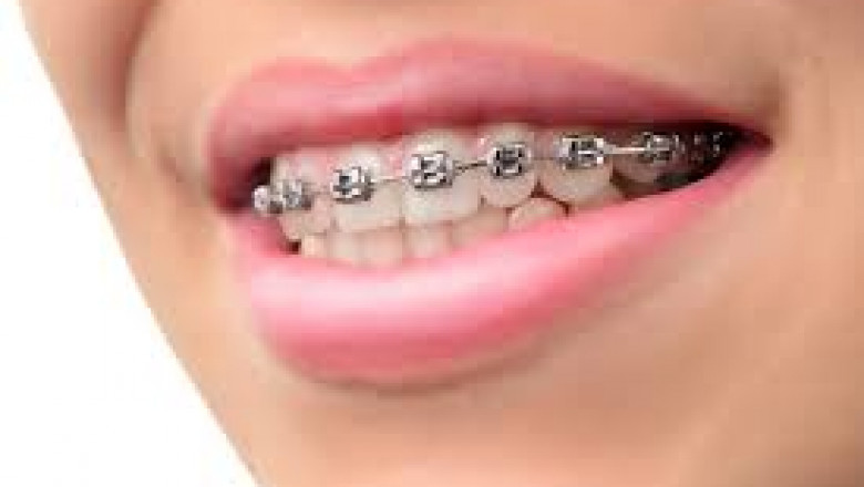 Can Adults Get Braces?